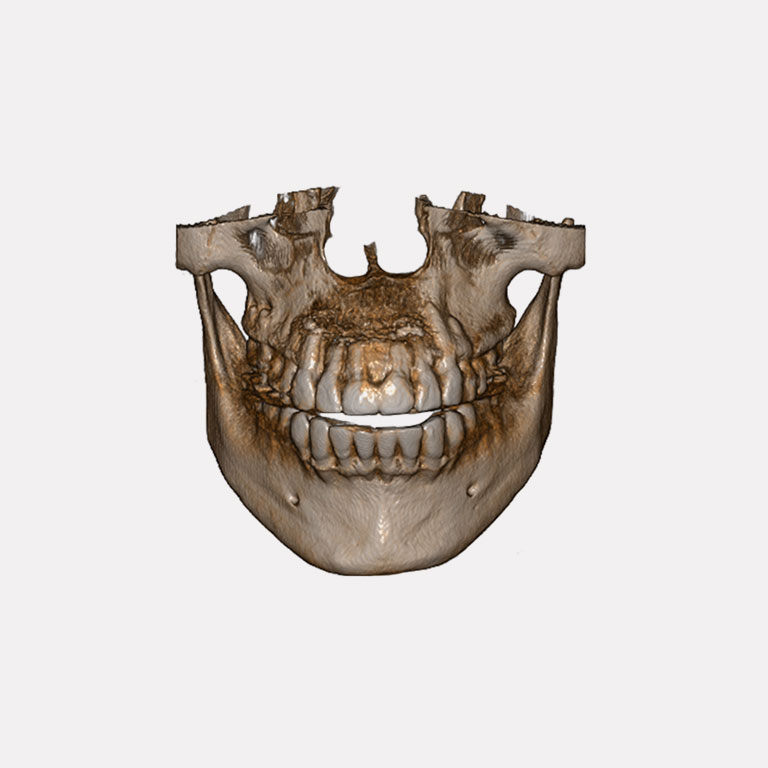 Tomografía dental 3D